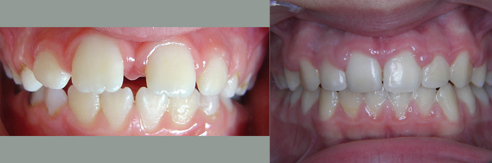 before - After